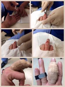 Minor hand surgery, from start to finish.